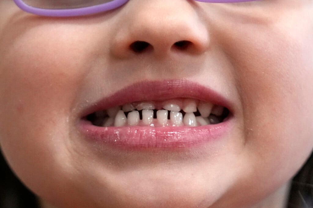 Fluoride Supplements Fda