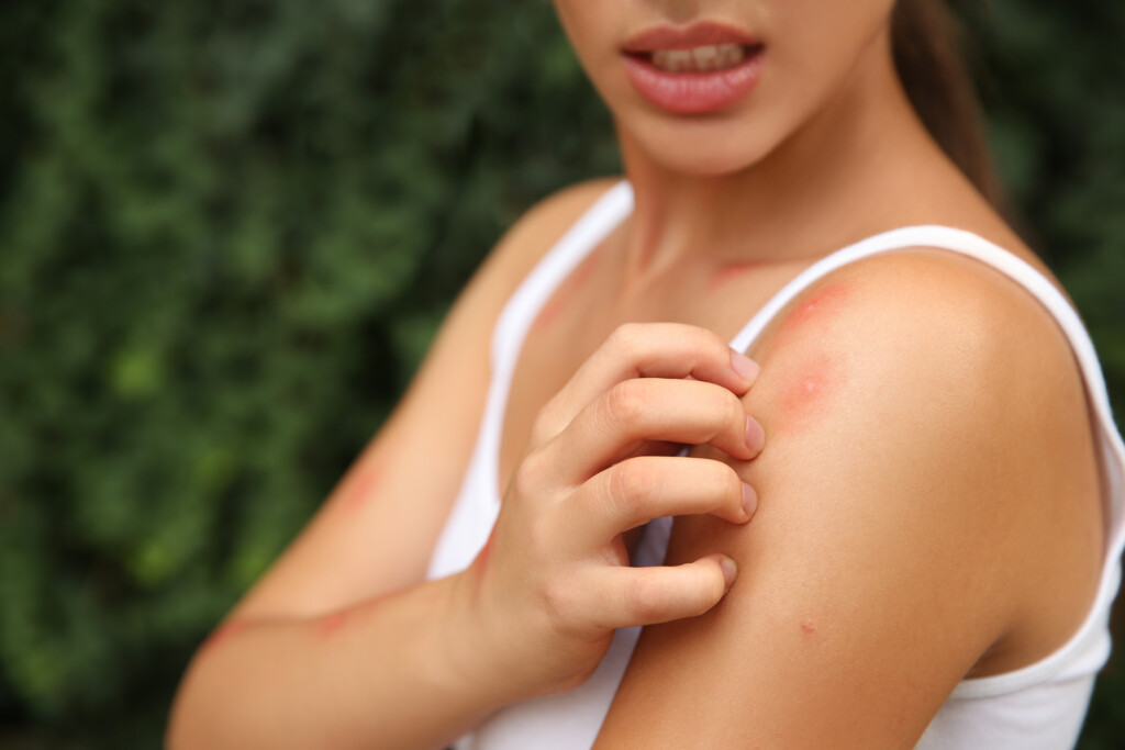 Woman Scratching Shoulder With Insect Bite Outdoors, Closeup