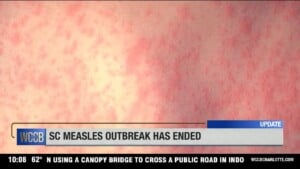 Sc Measles Outbreak Has Ended