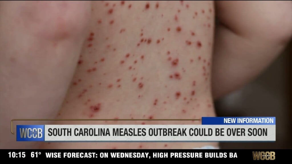 Sc Measles Outbreak Could Be Over Soon