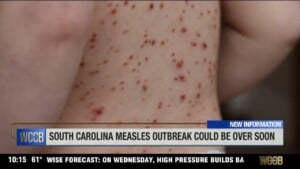 Sc Measles Outbreak Could Be Over Soon