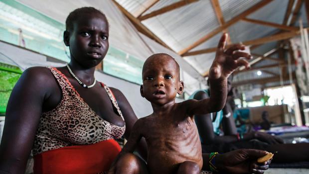 A woman holds a child with severe malnutrition at a clinic run by Doctors Without Borders (MSF) in Lankien