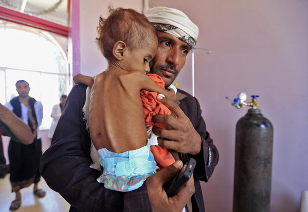A Yemeni man carries his child who is suffering from malnutrition into a treatment centre at a hospital in the capital Sanaa on October 6