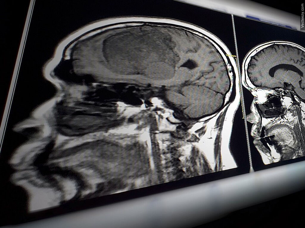 Brain