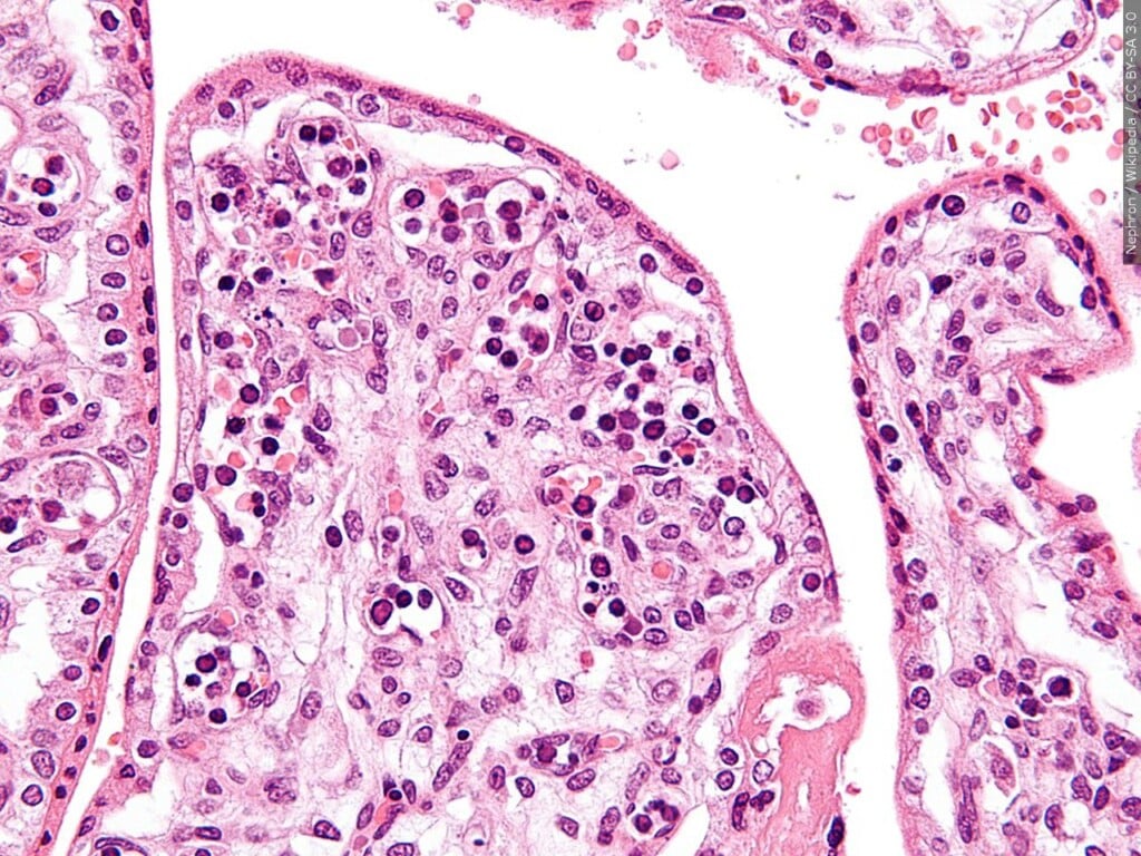 Parvovirus