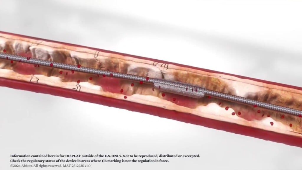 Tech Byte High Tech Tools From Vascular Institute Save Limbs And Lives
