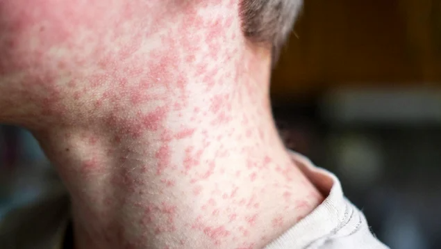 Measles