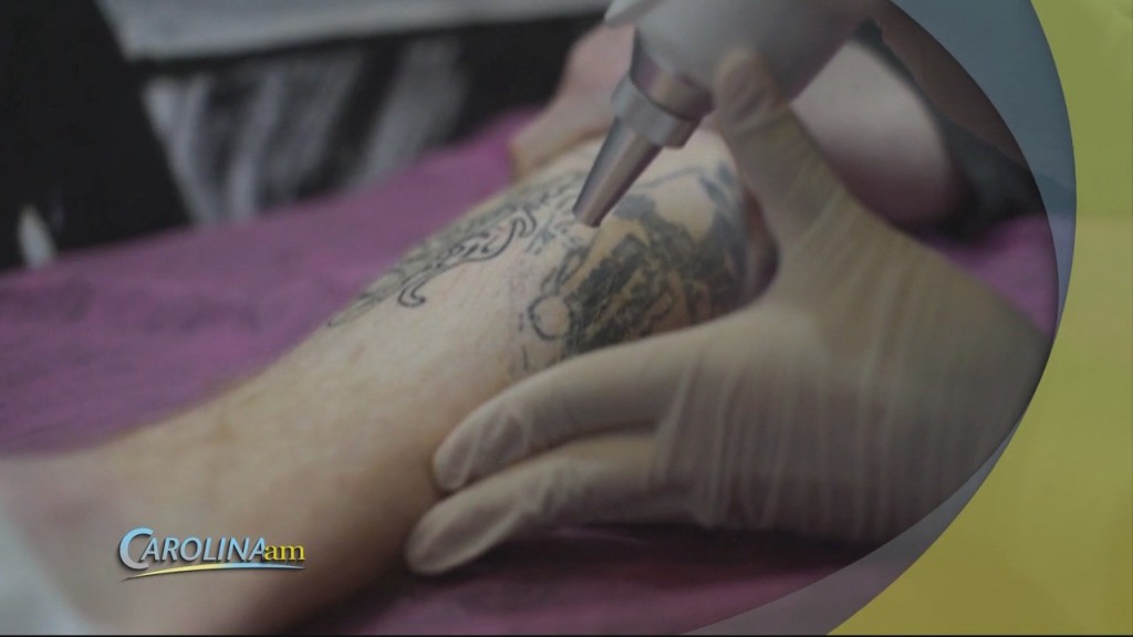 Tattoo Removals