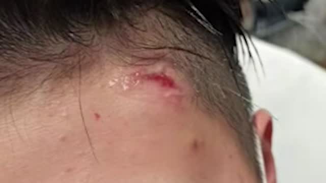 Ny: Asian Woman Attacked With Hammer Speaks