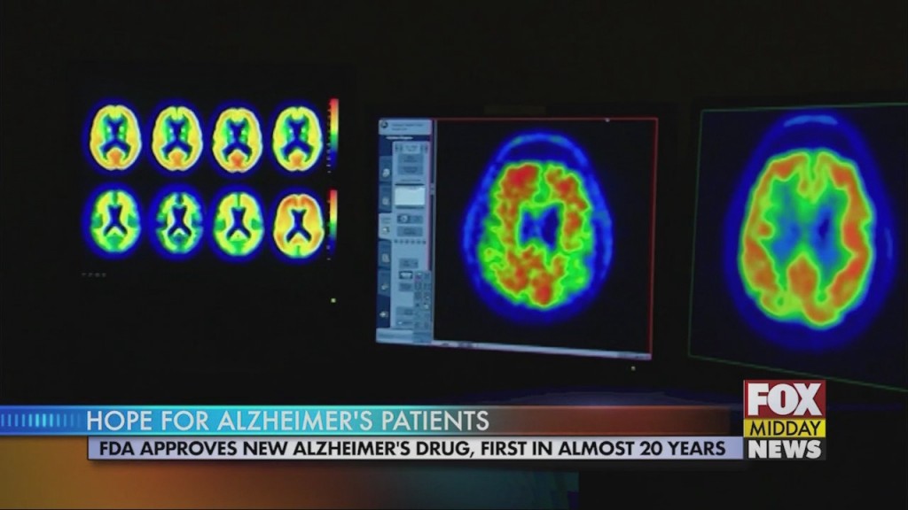 Alzheimers