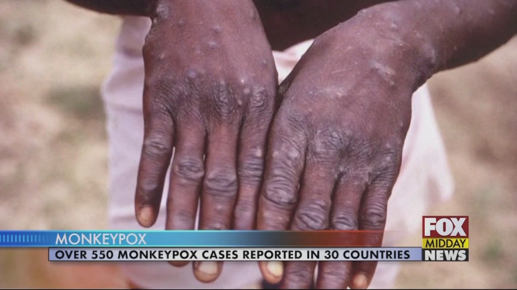 Monekypox