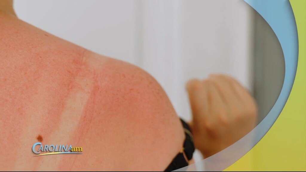 Sun Burns