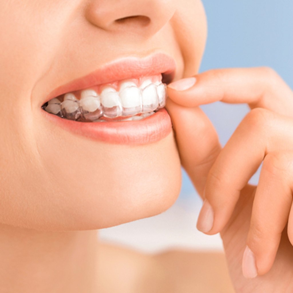 How To Get The Best Invisalign Results Possible WILMA magazine