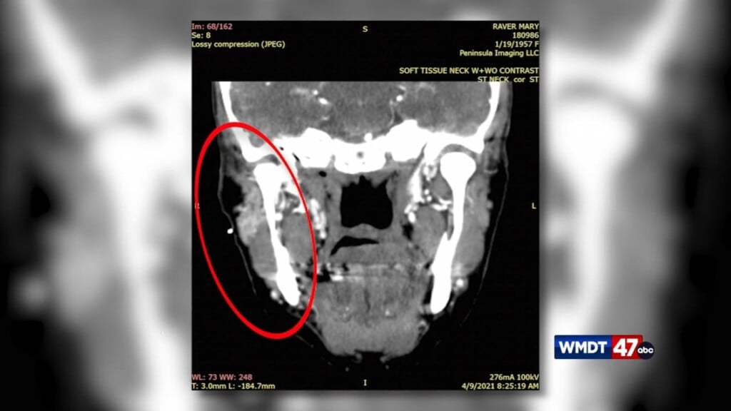 3.3m Malpractice Lawsuit