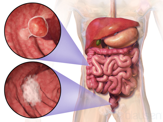 640px Blausen 0246 Colorectalcancer