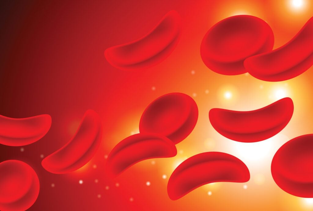 Sickle Cell 2