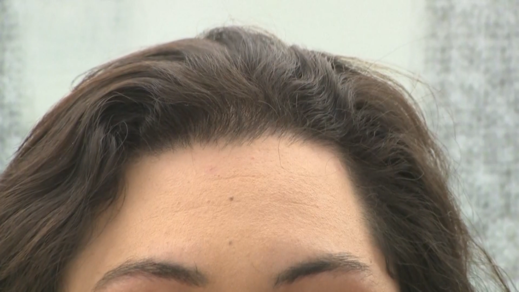 Hair Loss
