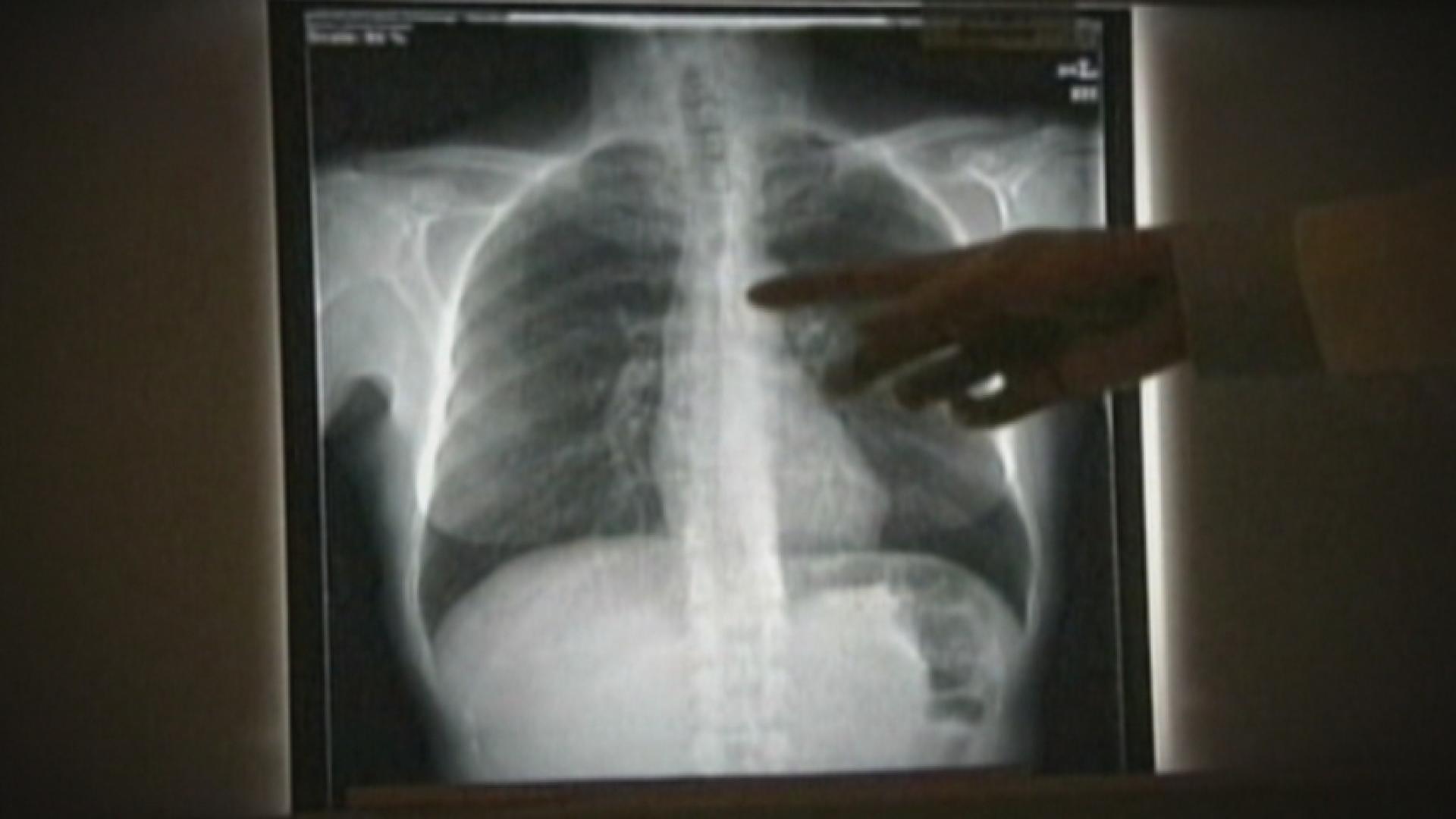 Lung Cancer: More Screenings Could Save Lives - News 40 | WNKY Television