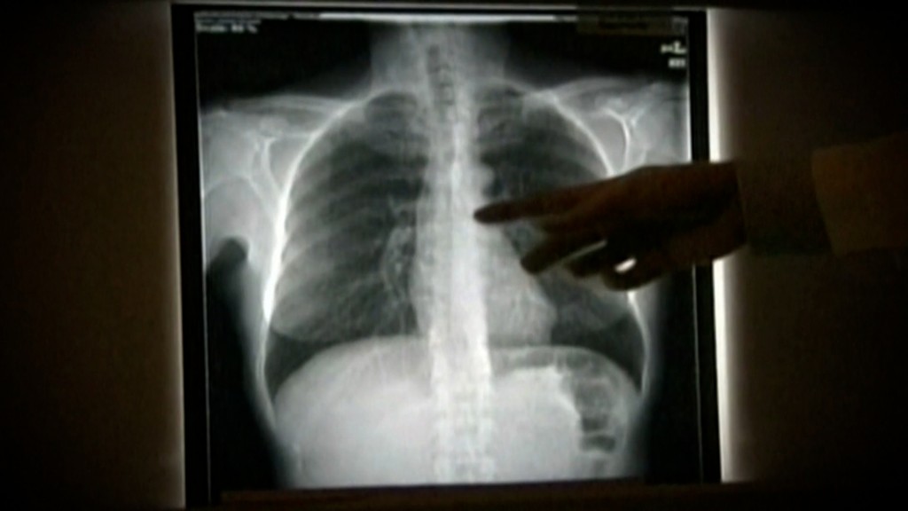 Lung Cancer