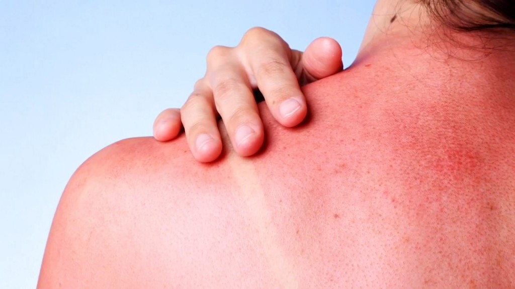 Skin Cancer