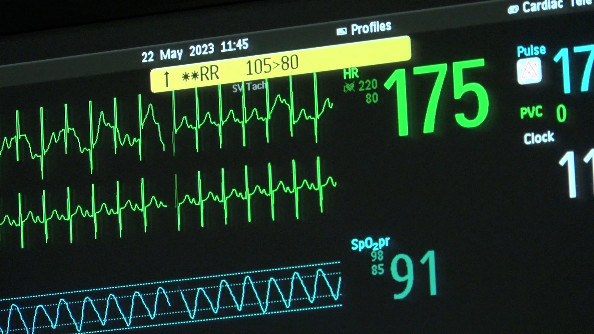 Rsv Cases On The Rise Wnky News 40 Television Rsv Cases On The Rise Wnky News 40 Television