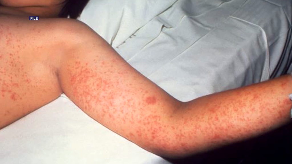 Measles
