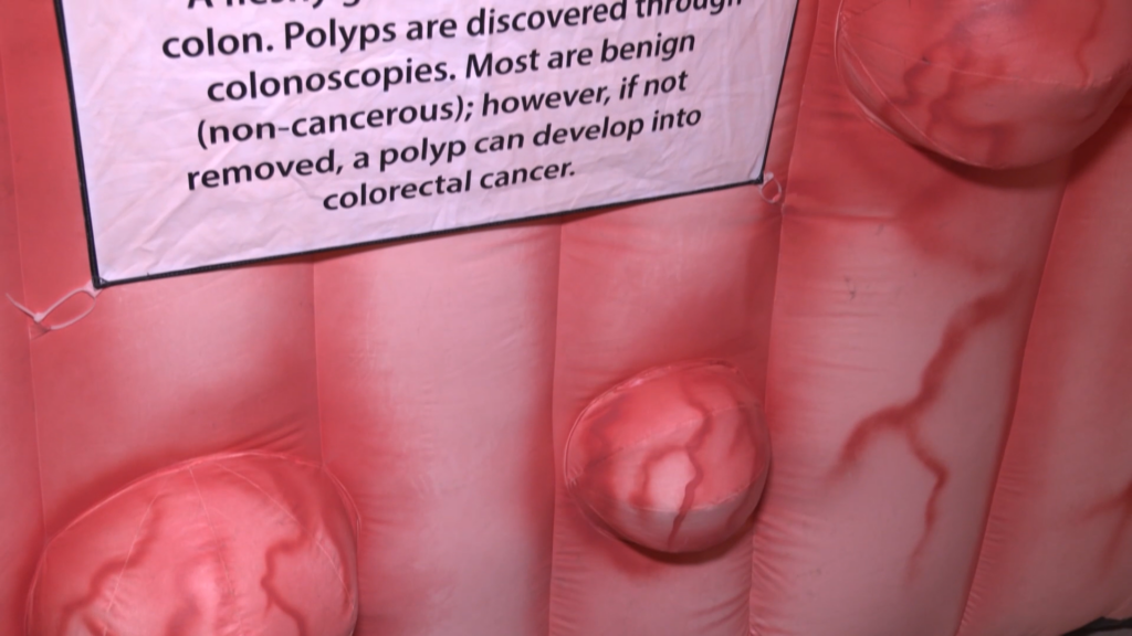 Polyps Colorectal Cancer