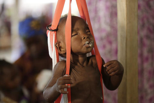 A malnourished child is weigh on a scale at a clinic run by Doctors Without Borders in Maiduguri Nigeria