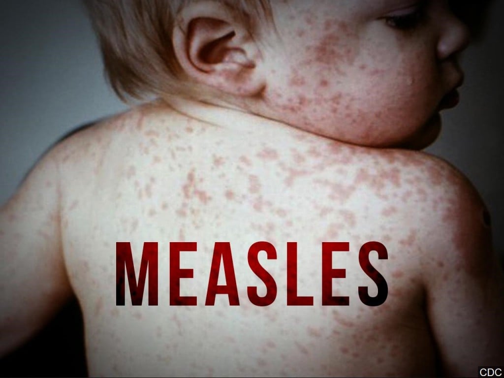 Measles outbreak