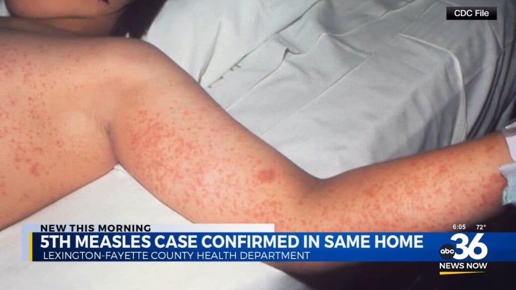 New Case Of Measles As Outbreak Continues In Central Kentucky