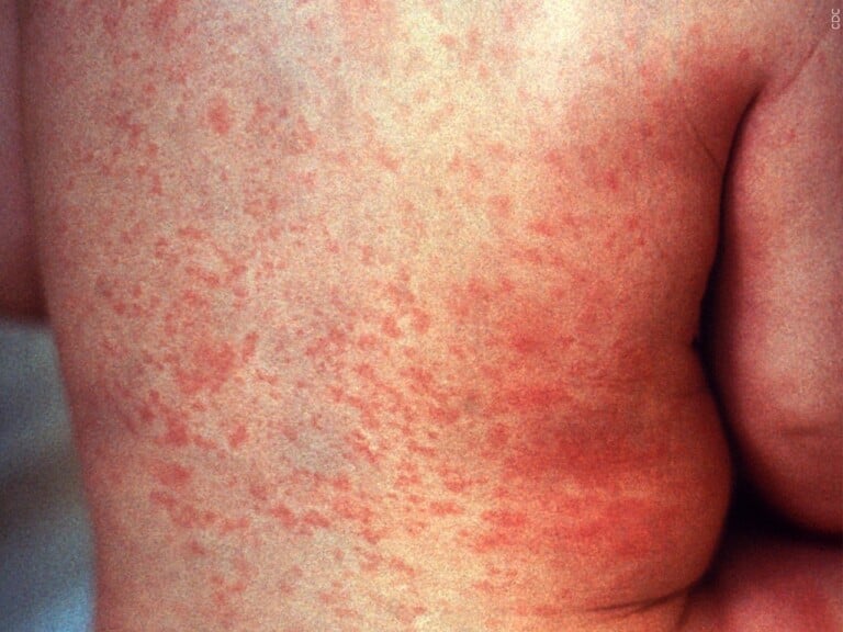 Measles