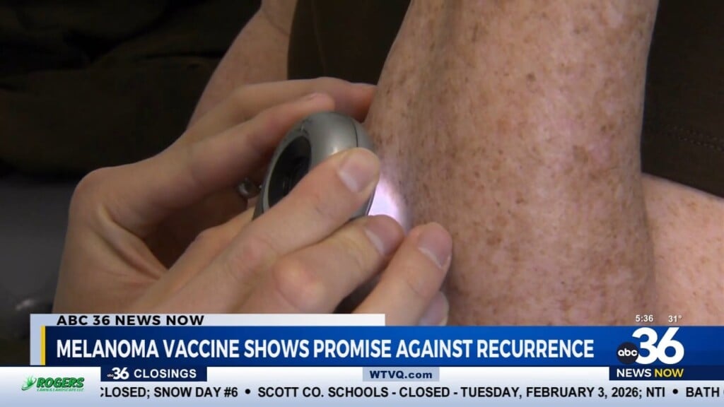 Melanoma Vaccine Shows Promise Against Recurrence