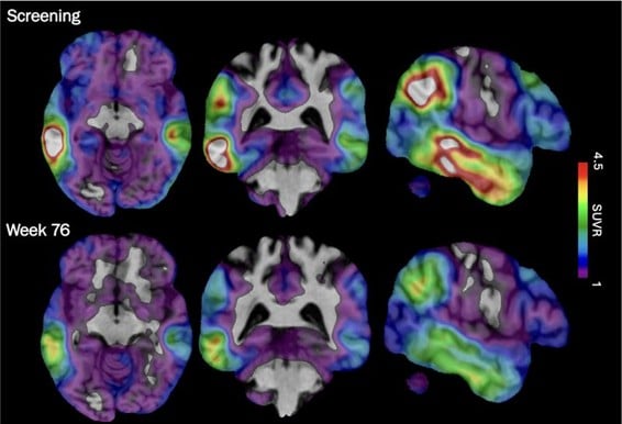 Alzheimers New Experimental Drugs