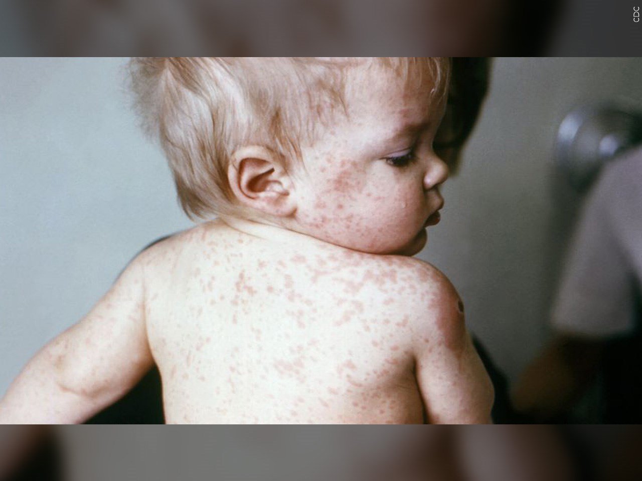 Measles vaccinations rate at lowest point since 2008, study finds
