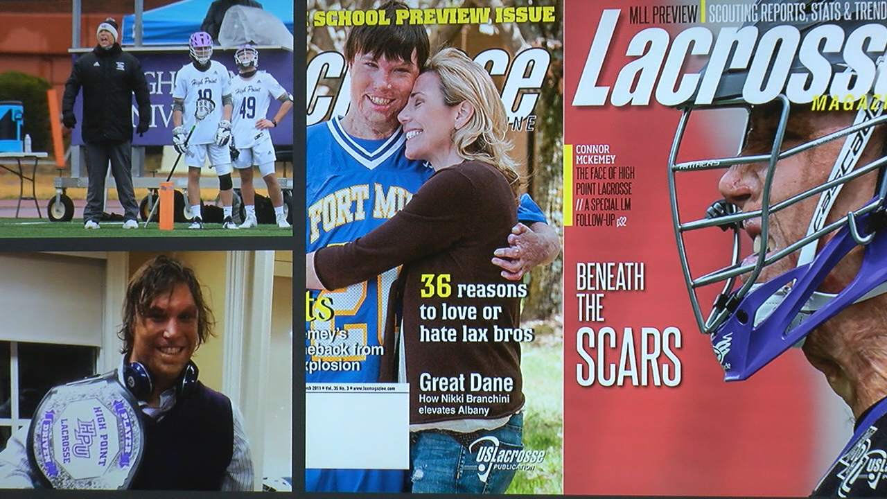 North Carolina burn survivor shares inspiring story, overcoming a 