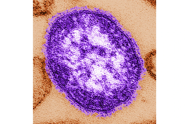 Measles